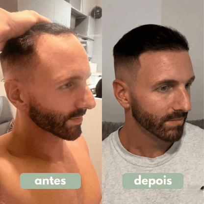 Reverse: Recupere a Densidade e Reduza a Queda em Até 30 Dias